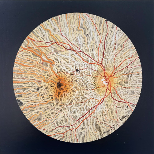 Pigmentary Degeneration of the Retina by Annette Smith Burgess